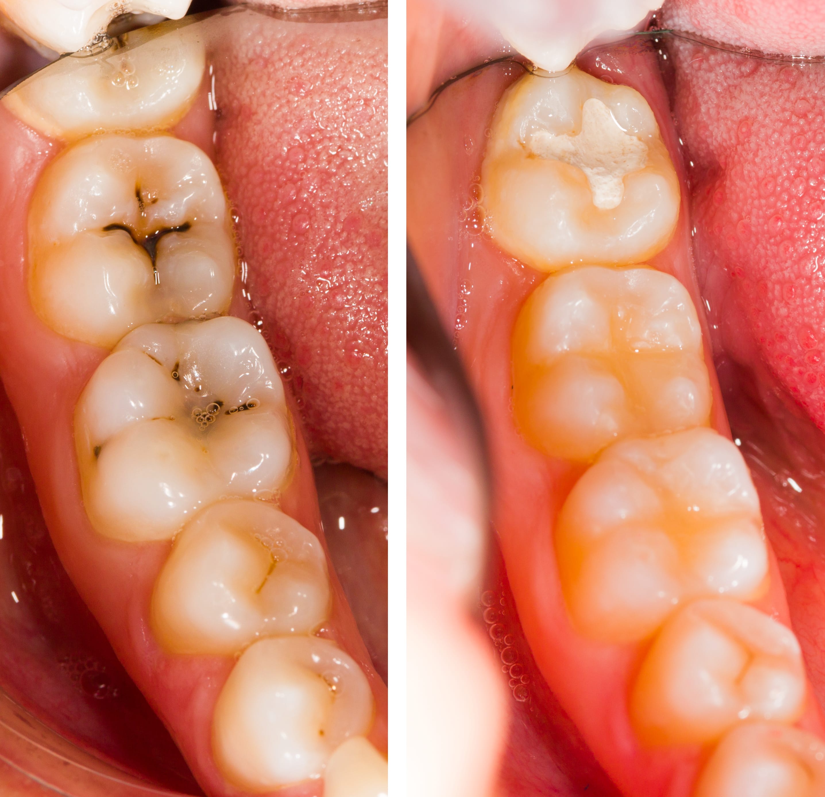 Diş dolgusu da içeren tedavi sonrası çürüklerden kurtulan dişler