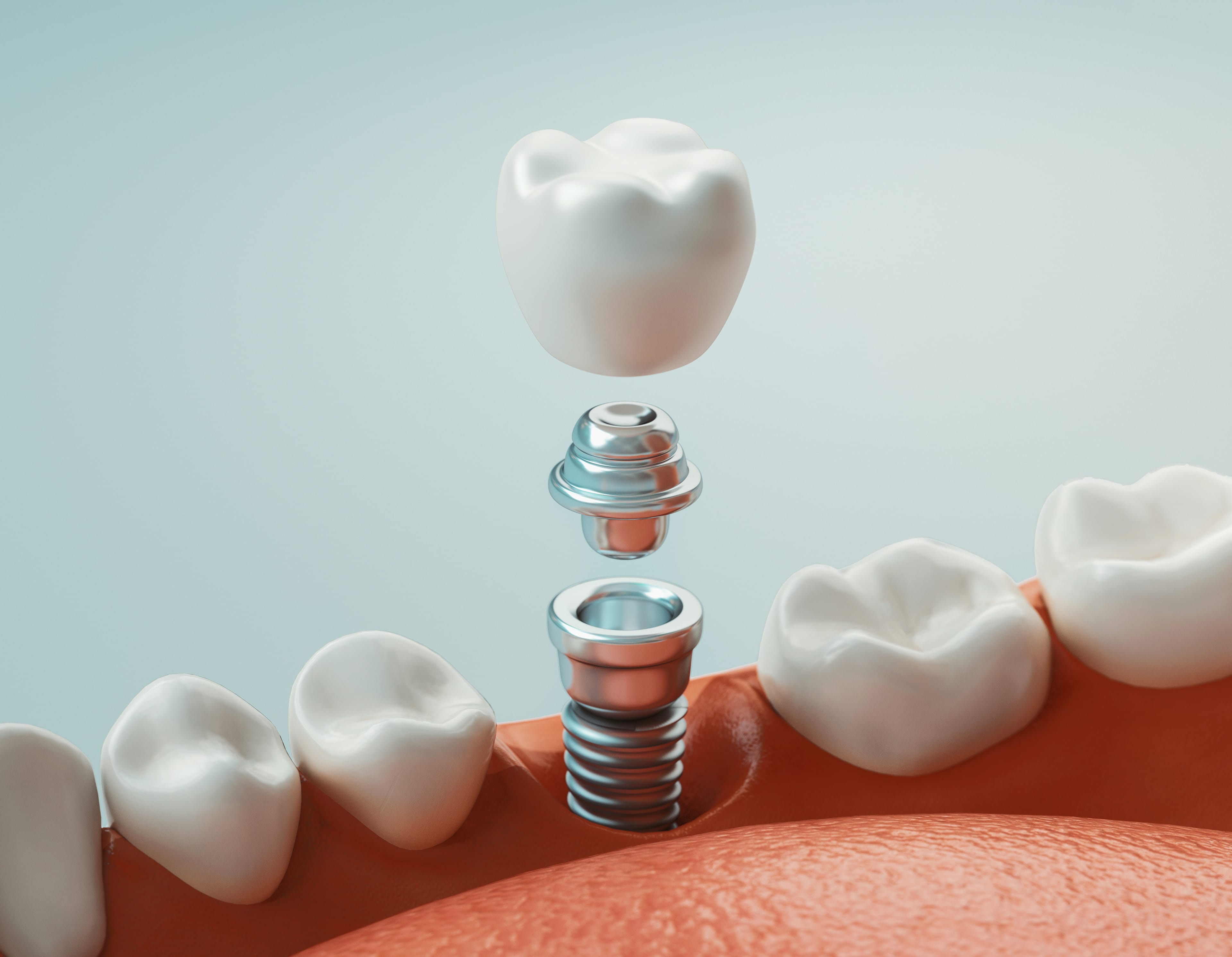 Diş implantını görselleştiren 3 boyutlu modelleme