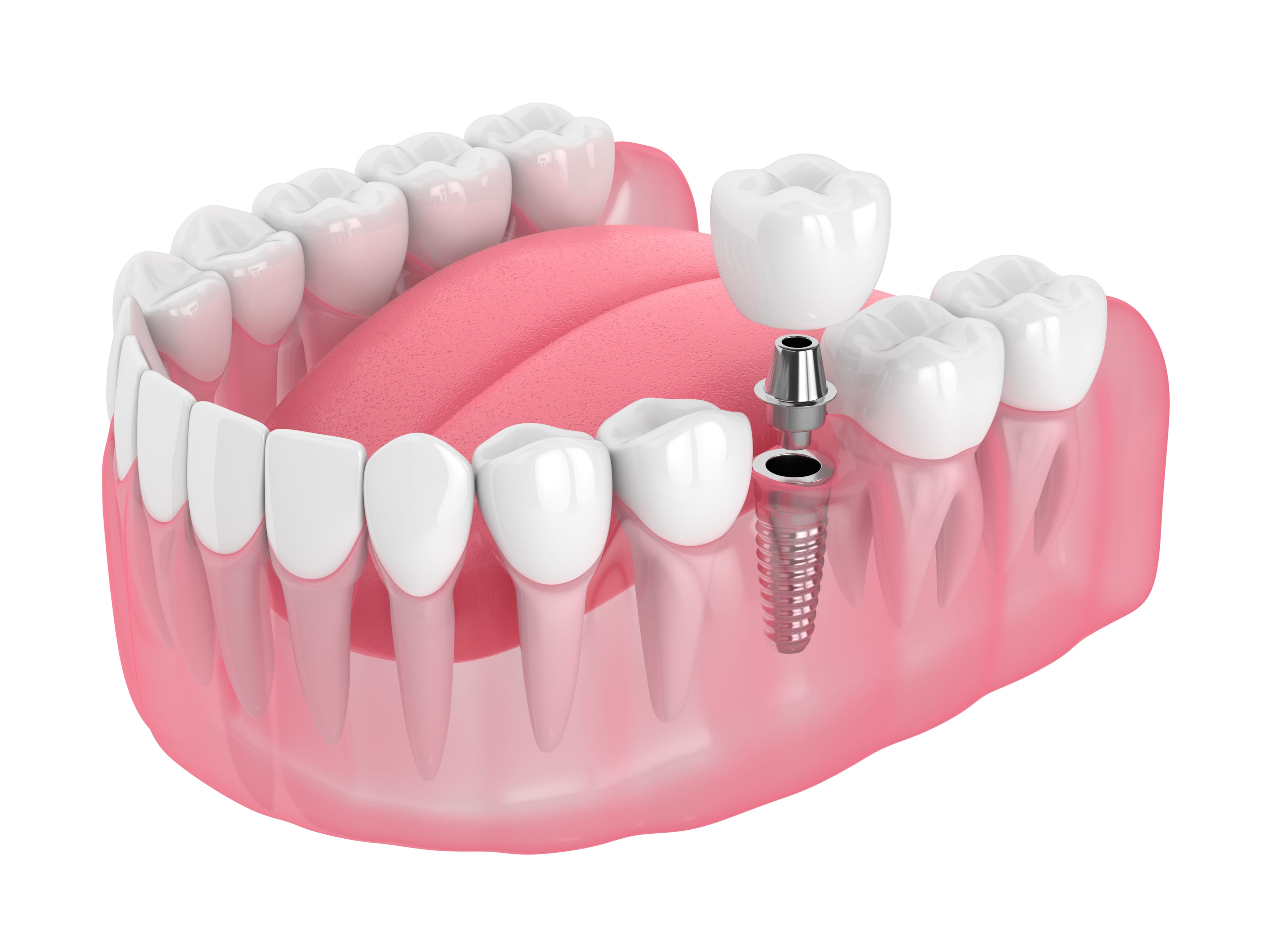 Diş implantını görselleştiren 3 boyutlu modelleme