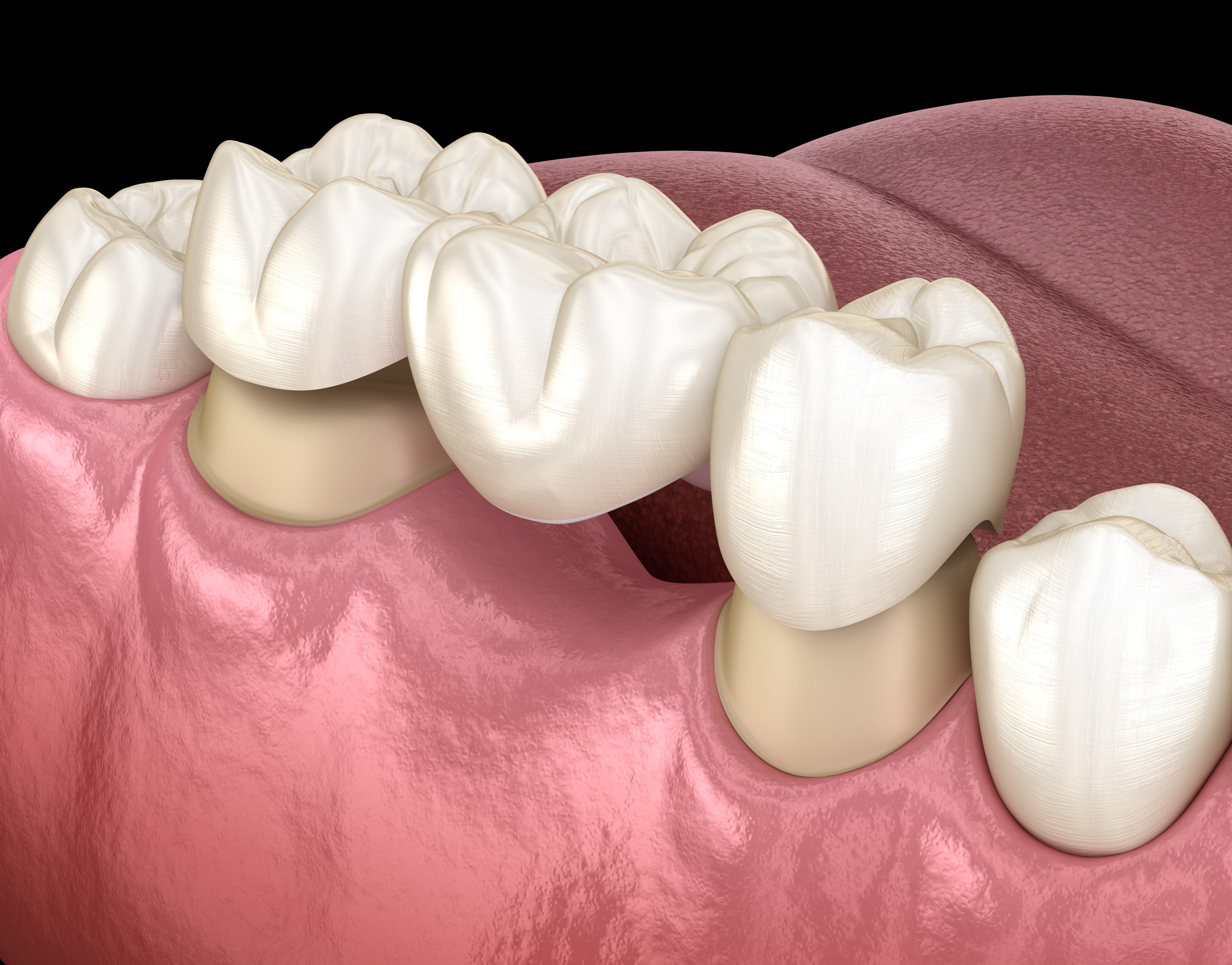 Diş kaplamasını görselleştiren 3 boyutlu modelleme