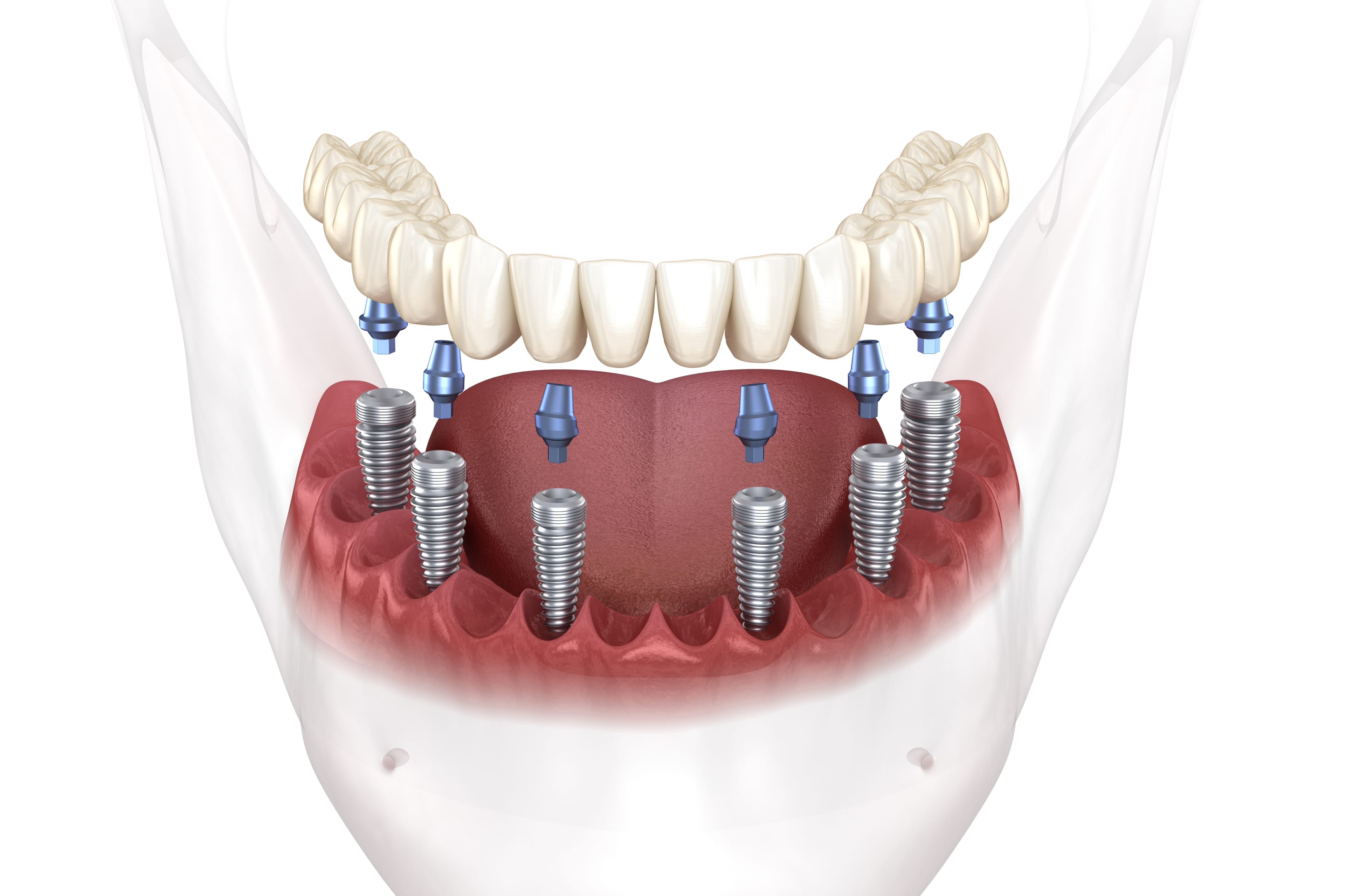 Diş implantını görselleştiren 3 boyutlu modelleme